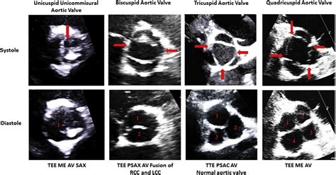 Unicuspid Aortic Valve Presenting With Decompensated Critical Aortic