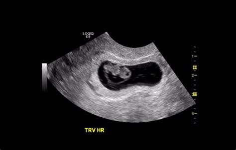 8 Week Ultrasound Babycenter