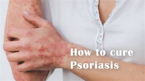 How To Cure Psoriasis Dr Aninditas Homeo Clinic