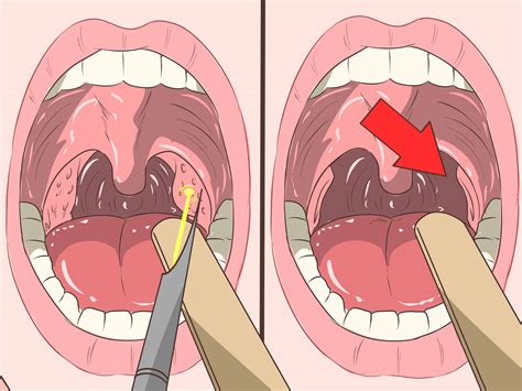 4 Formas De Quitar Piedrecillas De Las Amígdalas Tonsilolitos
