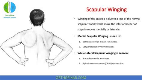 Scapular Winging Test Easy Explained Orthofixar Hot Sex Picture