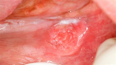 Oral Cancer First Stage