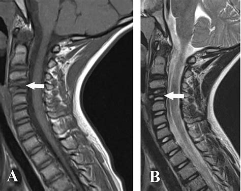 A T1 Weighted Mri Of The Cervical Spine Demonstrates Flattening And