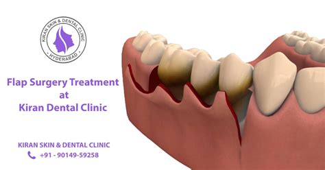 Flap Surgery Treatment In Hyderabad Kiran Dental Clinic