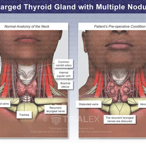 Enlarged Thyroid Gland With Multiple Nodules Trial Exhibits Inc