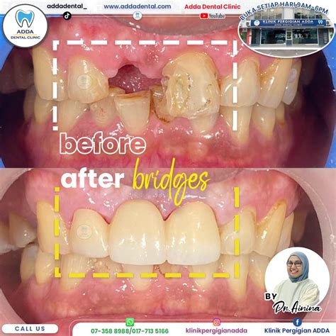 Best Braces Results In Jb Adda Dental Johor Bahru Jb