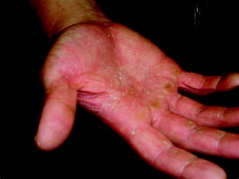Dermatitis On Top Of Hands