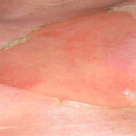 Erythematous Purpuric Macules And Papules On The Lower Limb Download