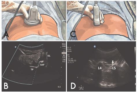 Ultrasound Guided Lumbar Facet Medial Branch Block And Intra Articular
