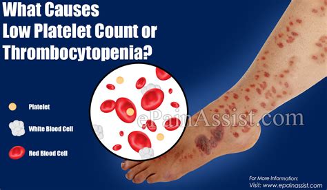 How To Increase Platelet Count Complete Howto Wikies