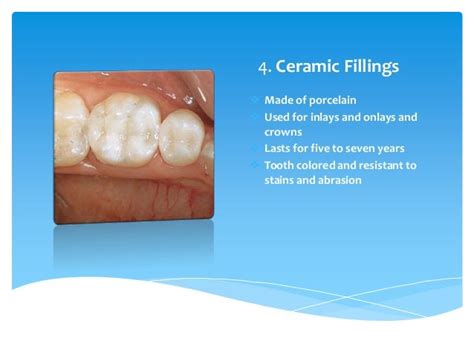 Different Types Of Dental Tooth Fillings For Cavities