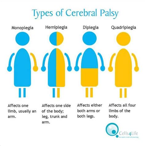 What Is Cerebral Palsy Health Blog Centre Info