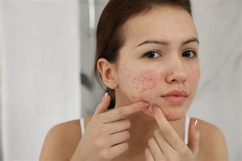 6 Effective Answers For How To Get Rid Of Red Spots On Face