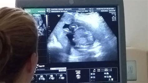 20 Weeks Pregnancy Ultrasound Youtube