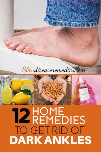 How To Get Rid Of Dark Ankles Thick Skin On Ankle Bone