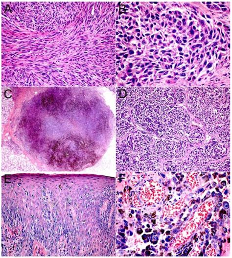 Histological Aspects Of Primary Oral Melanoma Hande A Oral Melanoma