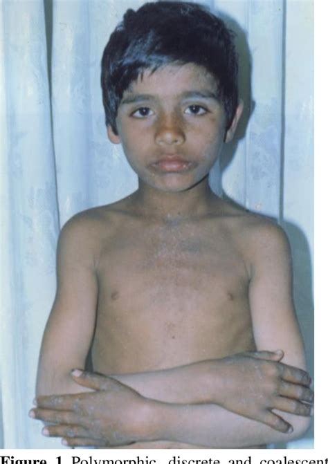 Figure From Epidermodysplasia Verruciformis A Rare Genodermatosis With Risk Of Malignant