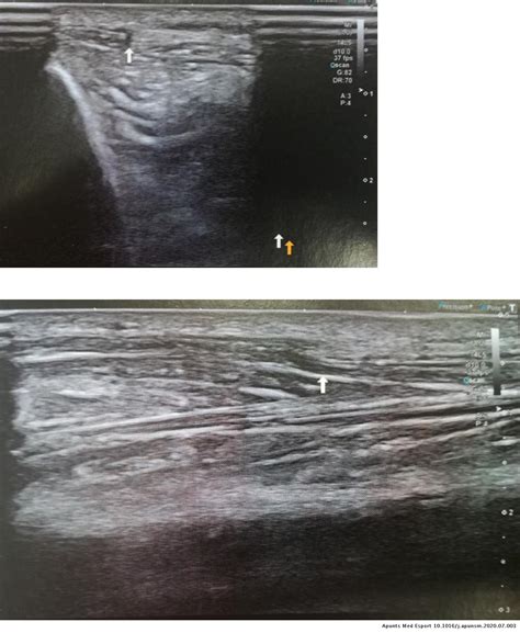 Tibialis Anterior Muscle Hernia A Rare Cause Of Leg Pain Case Report