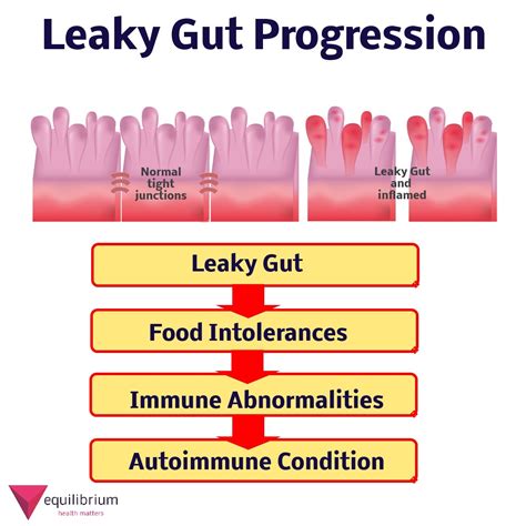 The Functional Medicine Approach To Digestive Health Leaky Gut