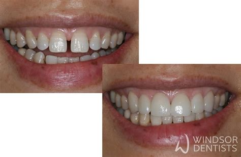 Veneers For Gap Teeth Before And After Teethwalls