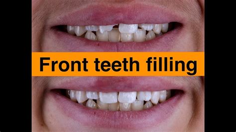 Front Teeth Filling Dental Clinic