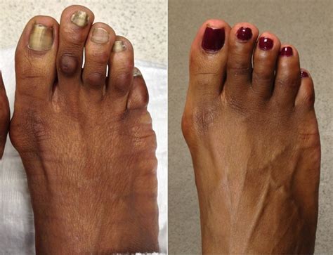 Cosmetic Toe Shortening Surgery