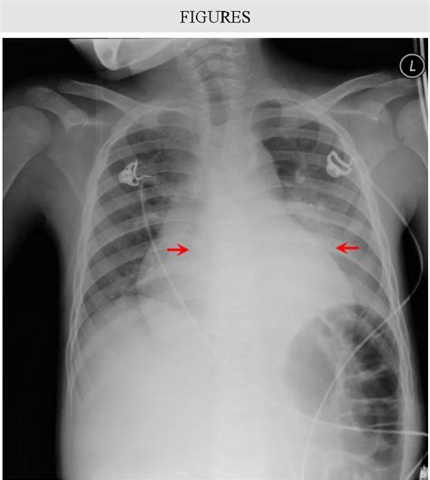 Figure 1 From A Case Of Rosai Dorfman Disease In A Pediatric Patient