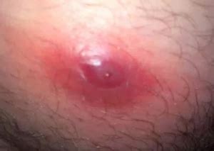 It is often as a result of continuous pressure or rubbing. Ingrown Armpit Hair: (Cyst, Lump, Bump), Lymph Node ...