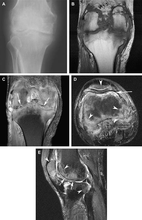 Mr Imaging Of Infectious Processes Of The Knee Magnetic Resonance