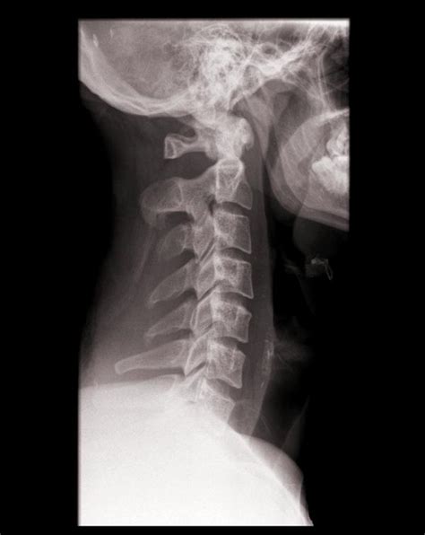 Ct Scan Spinal Gunshot With Destruction Of The Spinal Sexiezpix Web Porn