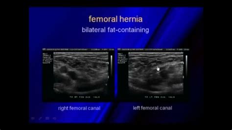 Ultrasound Of Hernias Ultrasound Pandora Screenshot Screenshots