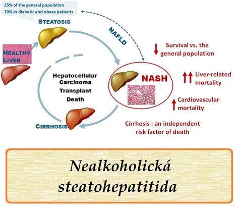Nealkoholická Steatohepatitida Nash Příznaky Projevy Symptomy