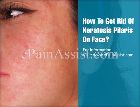 How To Get Rid Of Keratosis Pilaris On Face