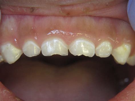 White Spot Lesions On Teeth