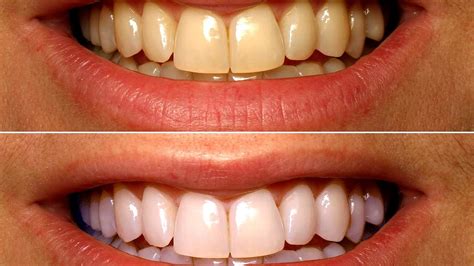 Teeth Whitening Dentist Before After White Choices