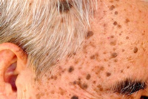 Skin Growths Epiphany Dermatology
