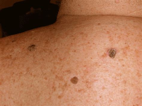 Seborrheic Keratosis Or Black Spots Laser Skin Seborrheic Keratosis