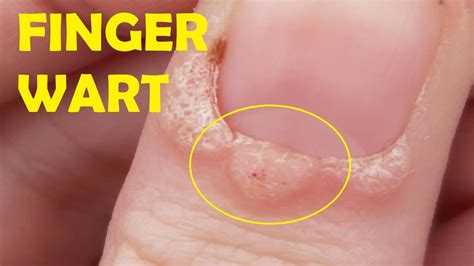 How To Get Rid Of Finger Warts Quick Youtube