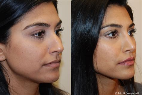 Eric M Joseph Md Rhinoplasty Before After Straightened Bridge And Tip Narrowing