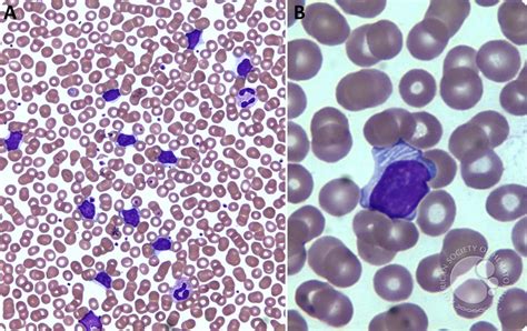 Abnormal Lymphocytes With Filamentous Like Cytoplasmic Inclusions In