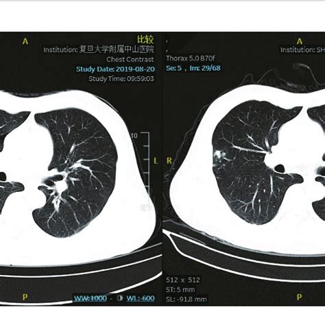 Chest Computed Tomography Scan The Chest Computed Tomography Lung