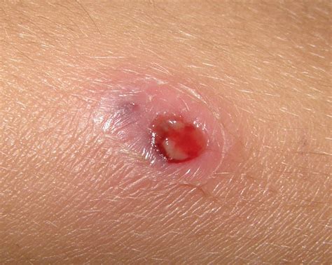 However, their bite is rarely fatal to humans. Black Widow Spider Bite Symptoms Pictures