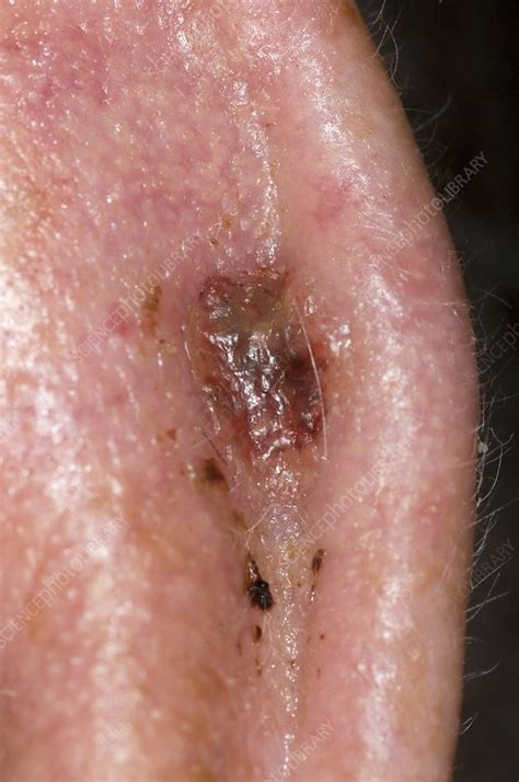 Skin Cancer On The Ear Stock Image C0083664 Science Photo Library