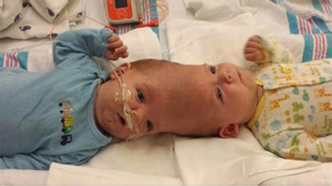 Conjoined Twins Separated Undergo Surgery As Individuals Fox31 Denver
