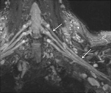 High Resolution 3t Mr Neurography Of The Brachial Plexus And Its