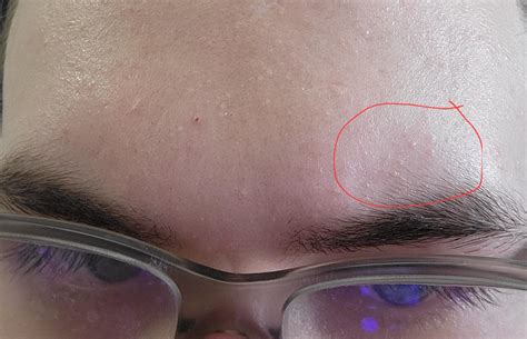 What Are These Small Bumps All Over Face And Forehead Rmedical