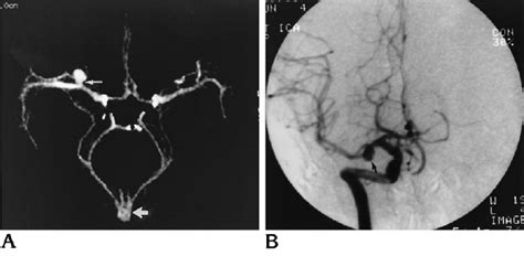 A And B The Lobulated Right Posterior Communicating Artery Aneurysm