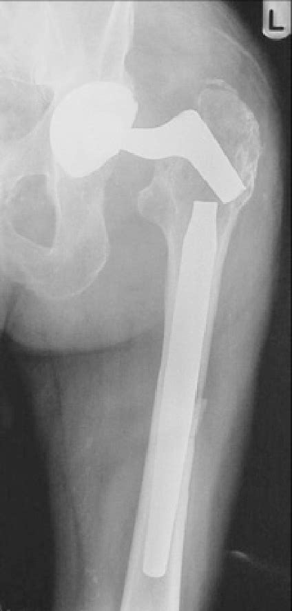 Anteroposterior Radiograph Of The Left Hip With Fractured Revision