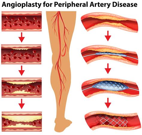 Peripheral Artery Disease Is Common But Not Unavoidable Or Untreatable