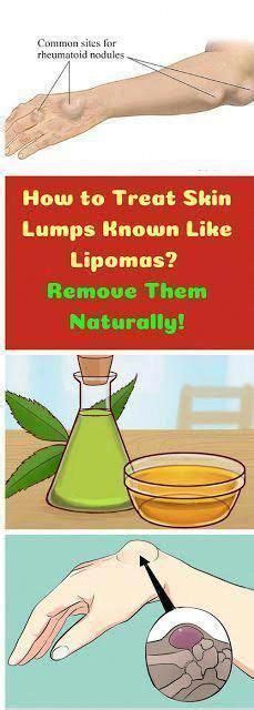 Vital Pieces Of Lumps On Neck Healthy Medicine Tips Treat Skin